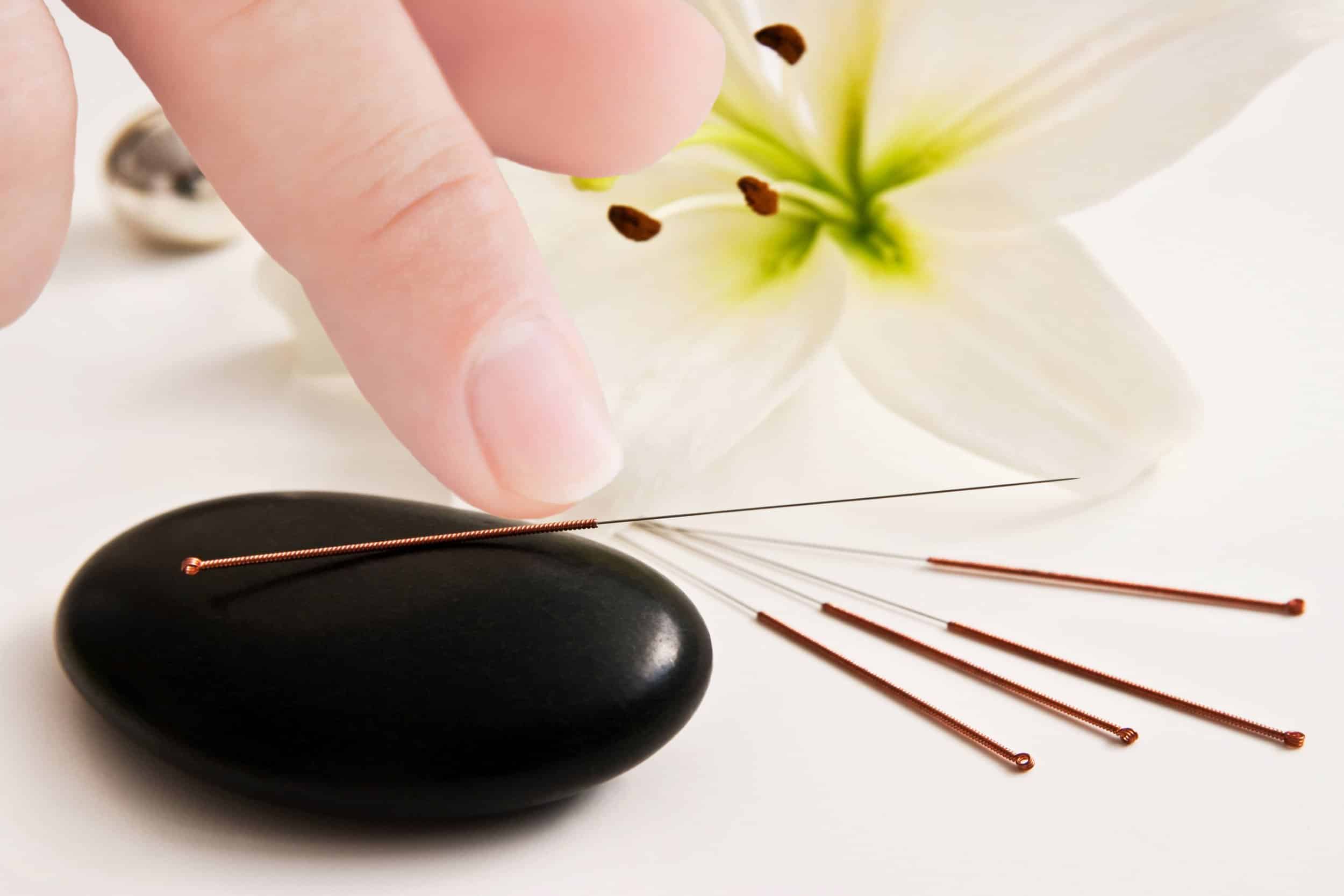 I benefici dell’agopuntura nella vita quotidiana